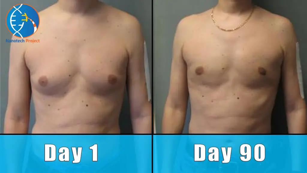 gynecomastia before and after treatment