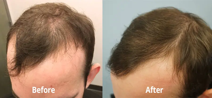 Hair loss results