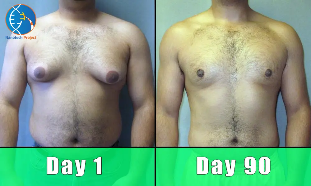 man boobs before and after treatment