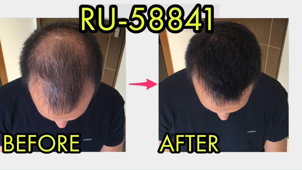 RU 58841 Side Effects