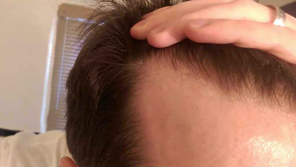 scalp hair