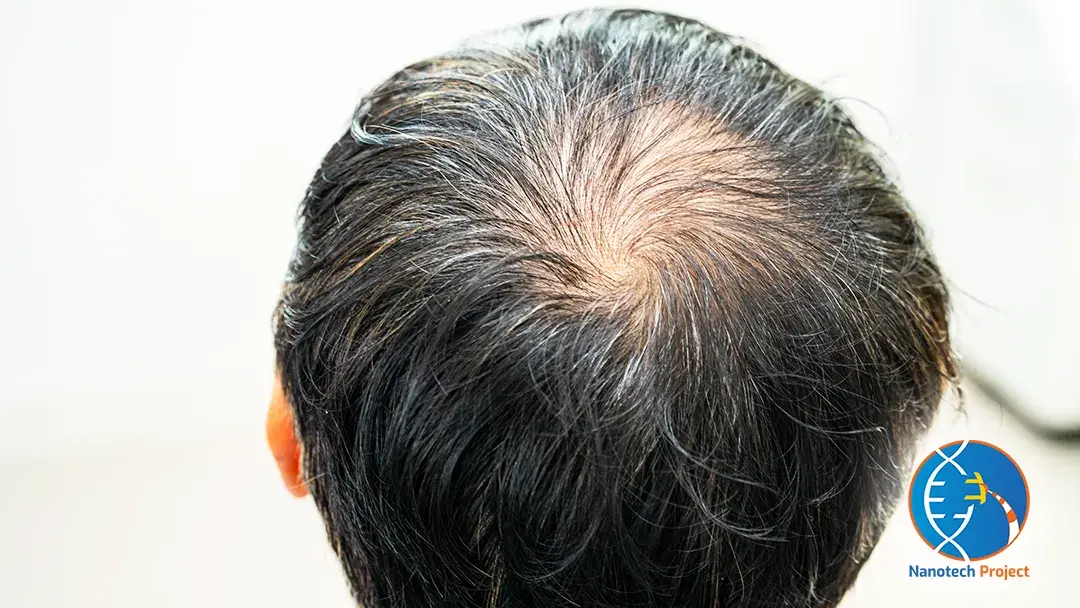 Do SARMs Cause Hair Fall | Feature Image